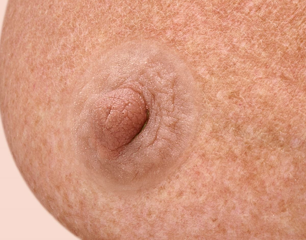 Op maat handgemaakte tepelprotheses