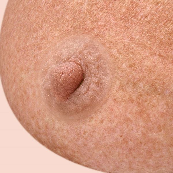 Tepelprotheses handgemaakt