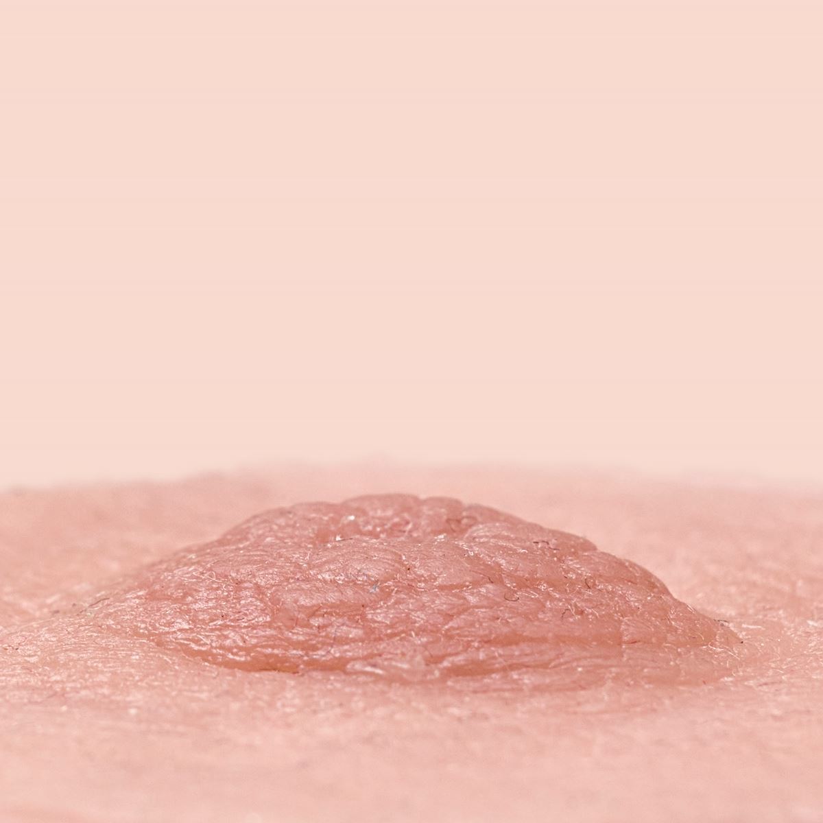 Tepelprotheses koraal